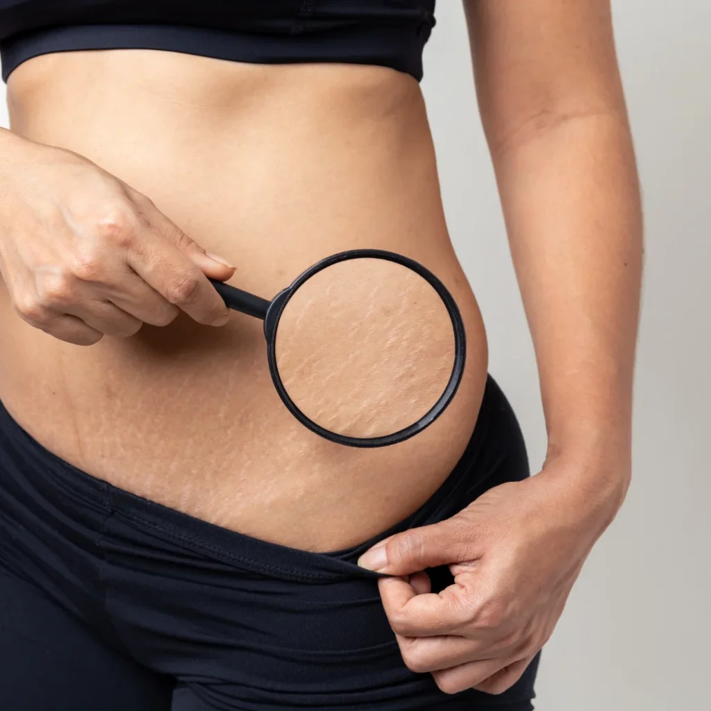 4EyMummyMakeover post-pregnancy body contouring treatment in Calicut