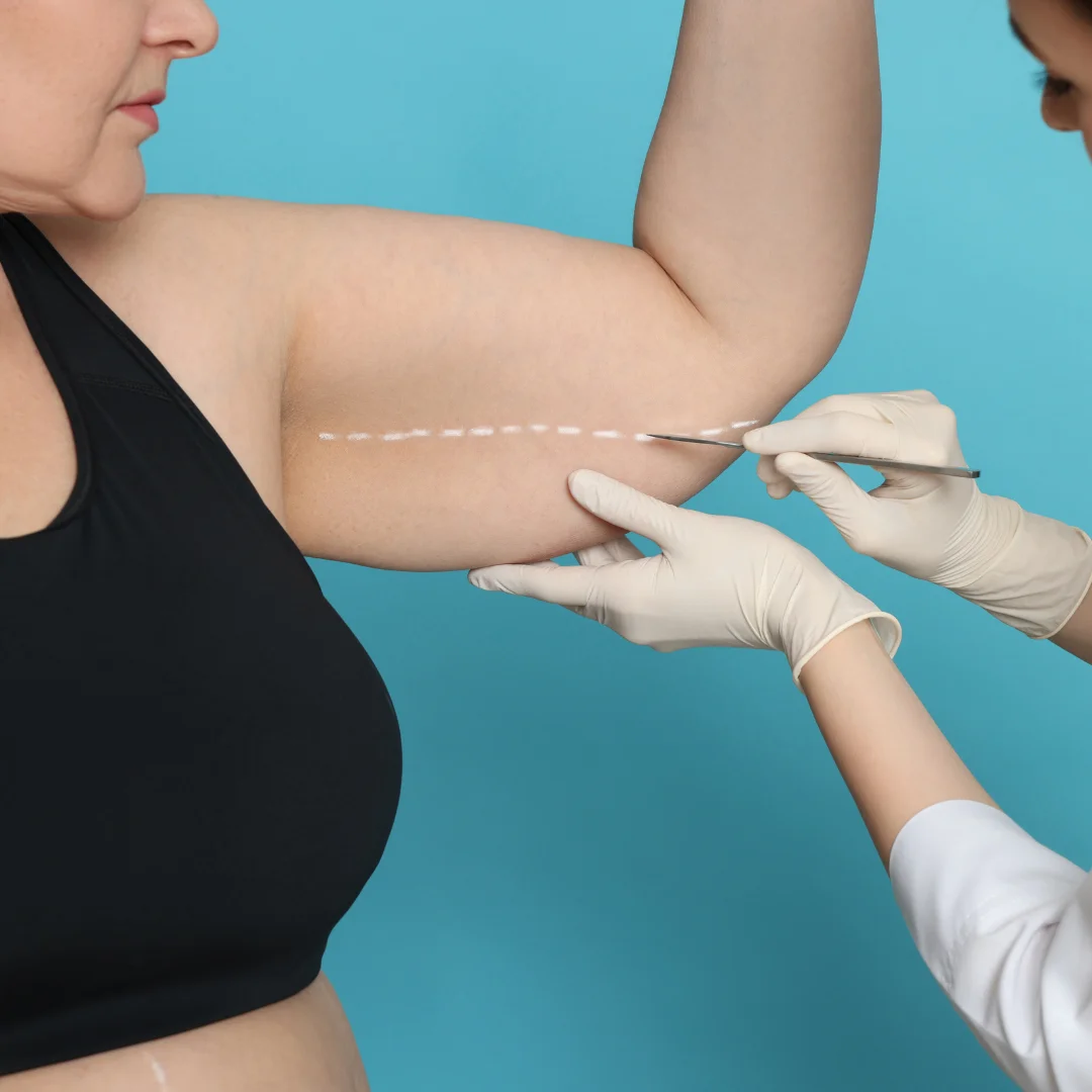 Arm and thigh liposuction treatment for body contouring in Calicut