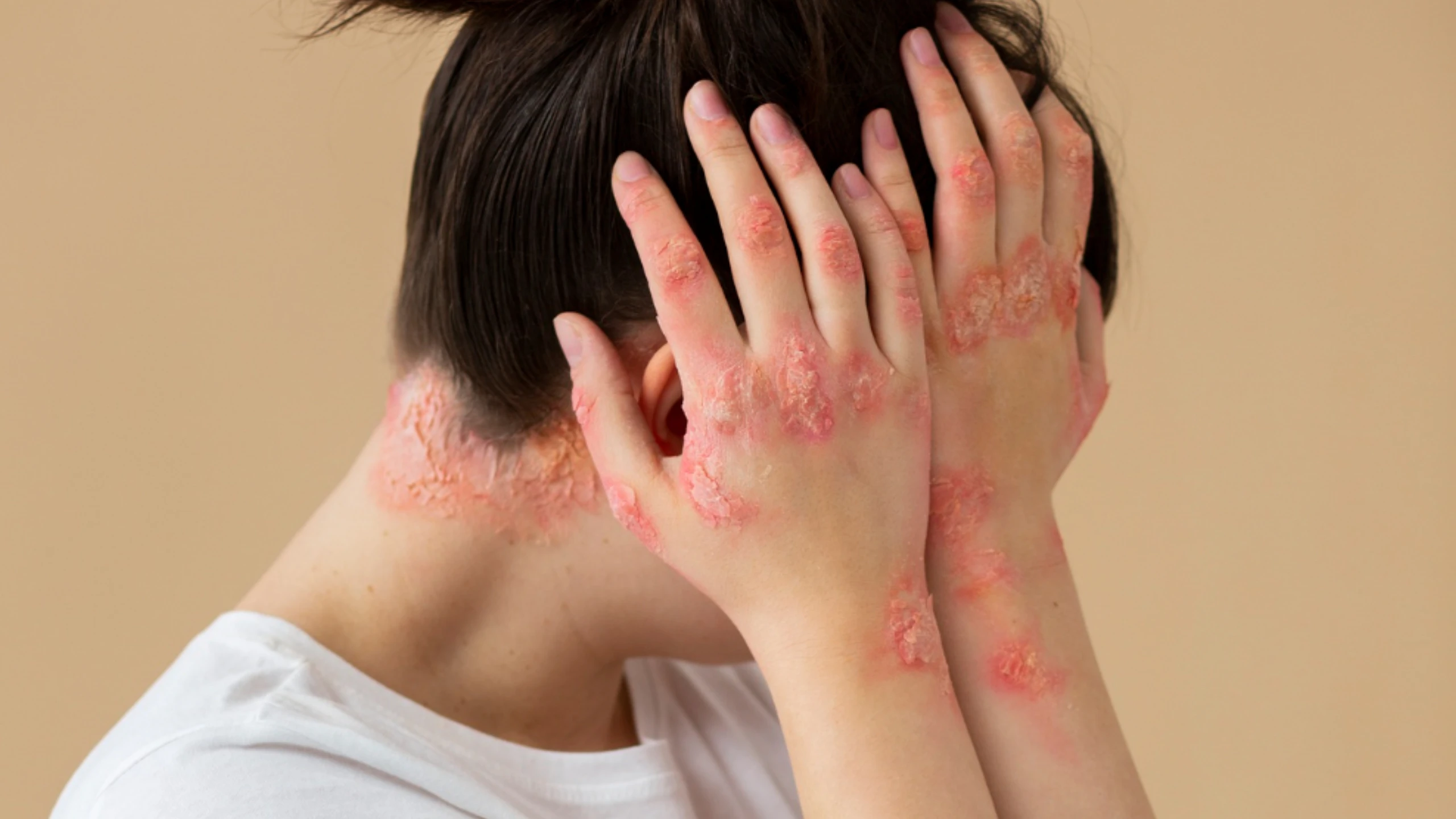 Biologic therapy for atopic dermatitis in Calicut