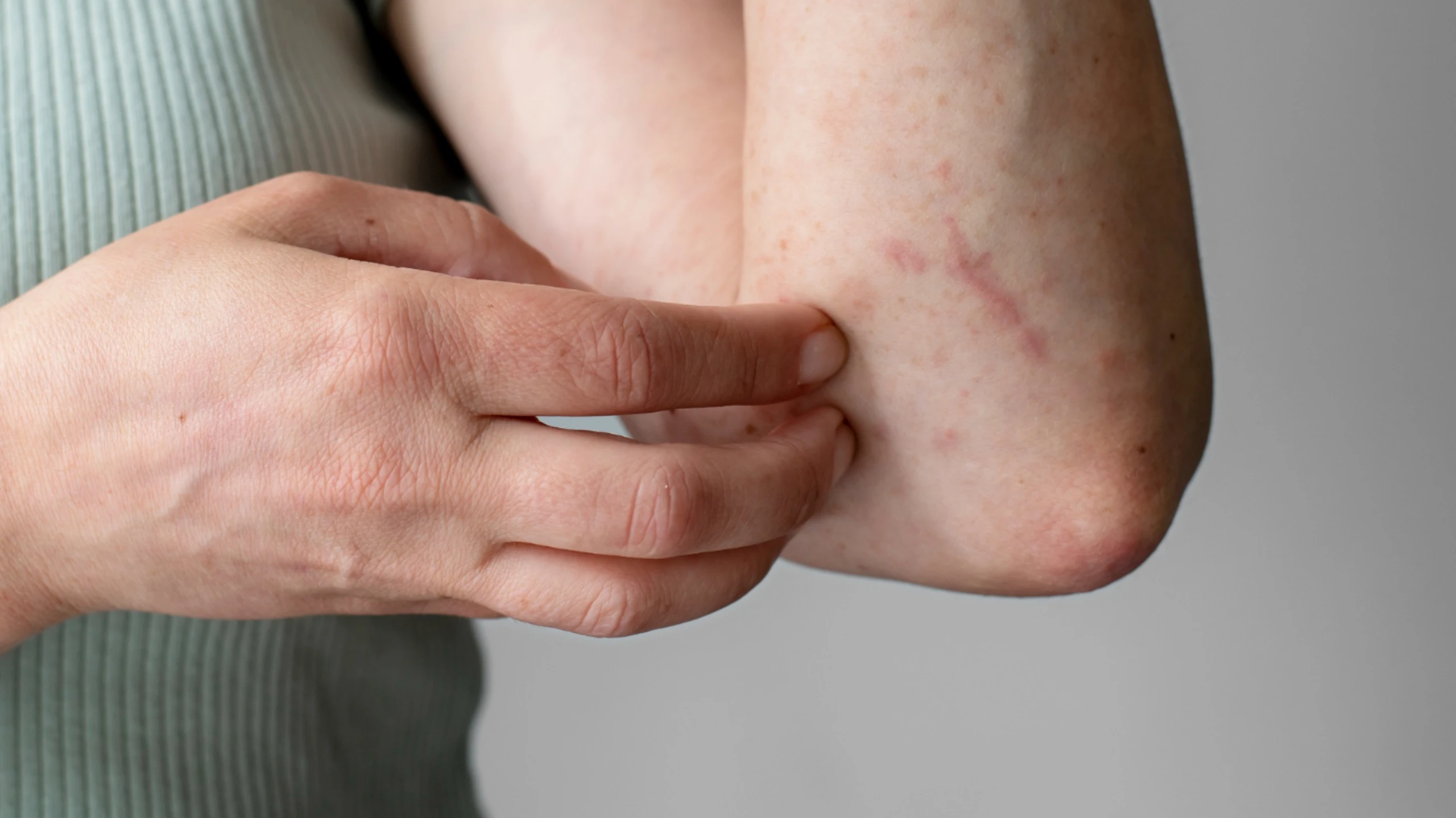 Biologic treatment for chronic urticaria in Calicut