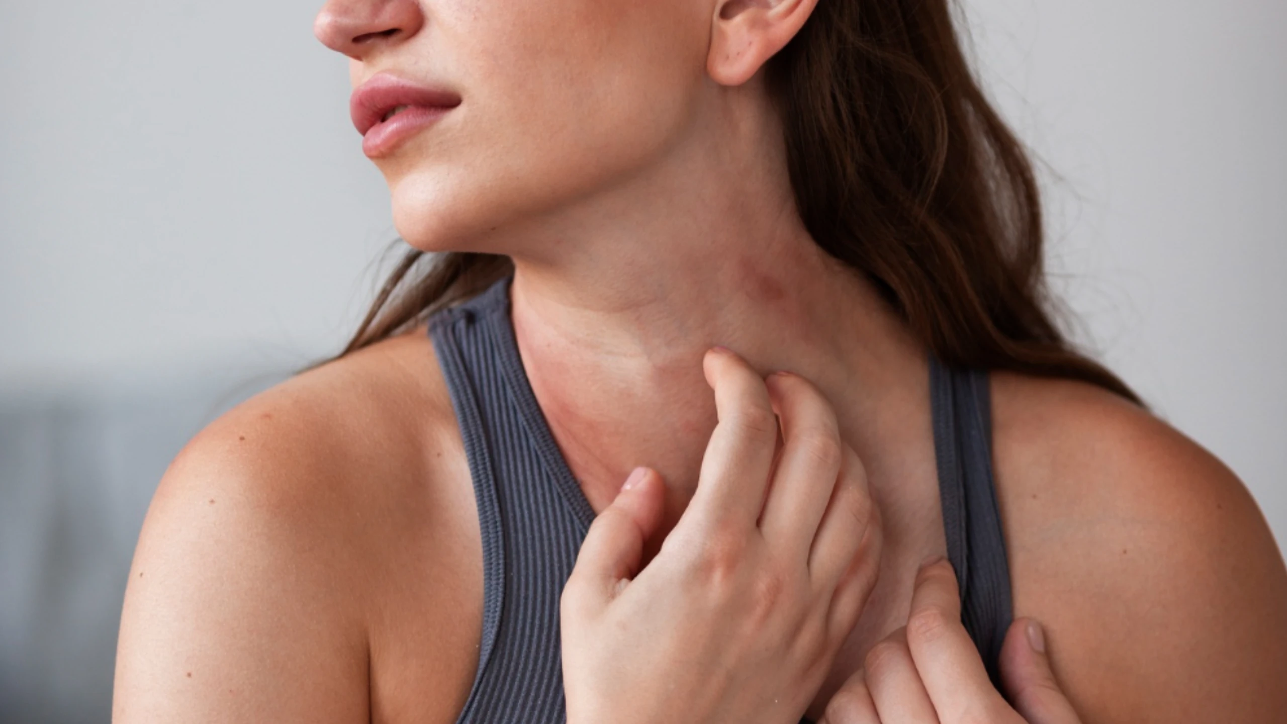 Targeted biologic therapy for hidradenitis suppurativa in Calicut