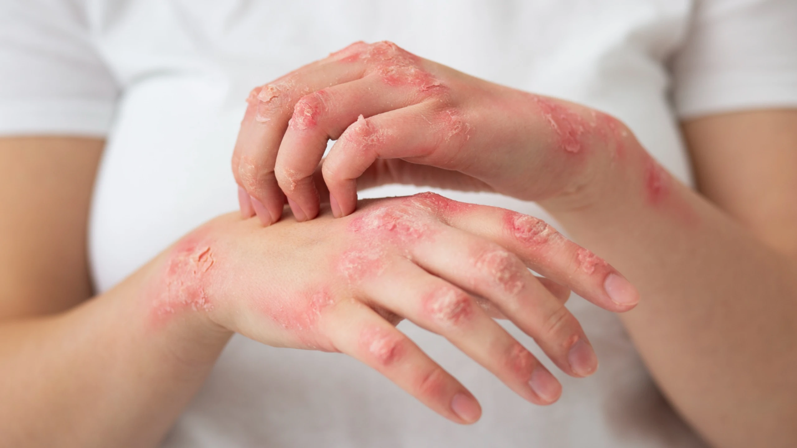 Biologic treatment for psoriasis in Calicut