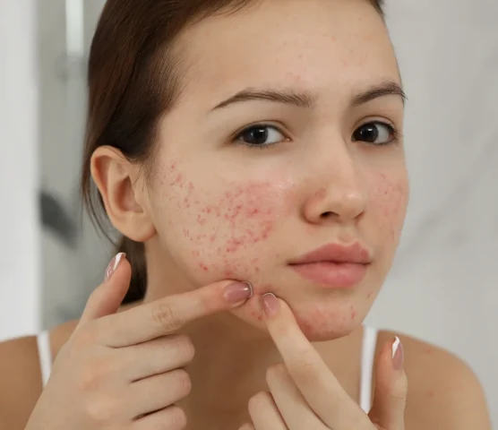 Atopic dermatitis (67)